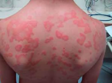 Allergic reaction - man's back