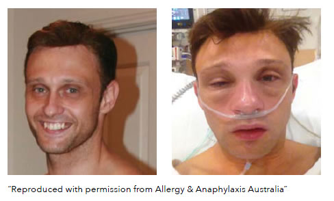 Severe allergic in a man
