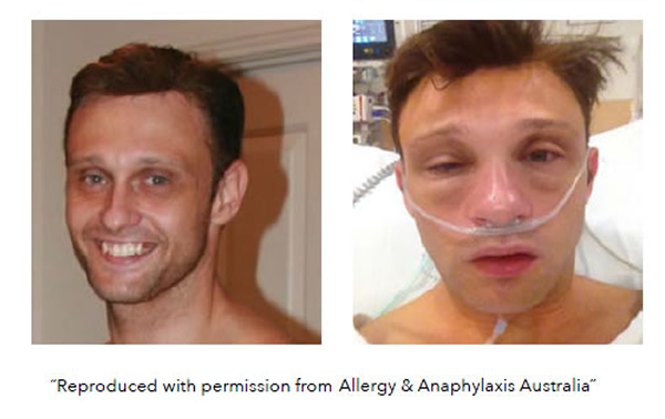 severe allergic man 600